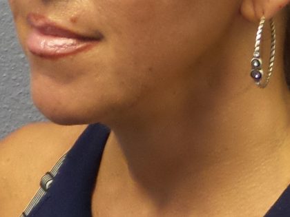 Liposuction of the Neck Before & After Patient #413