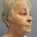 Liposuction of the Neck Before & After Patient #393