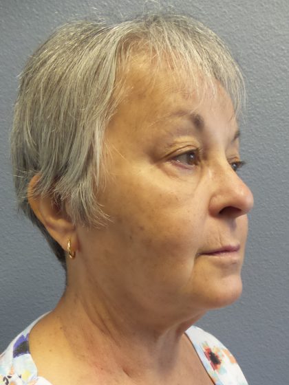 Liposuction of the Neck Before & After Patient #393