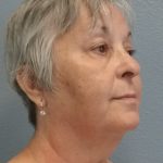 Liposuction of the Neck Before & After Patient #393