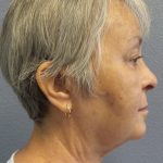 Liposuction of the Neck Before & After Patient #393