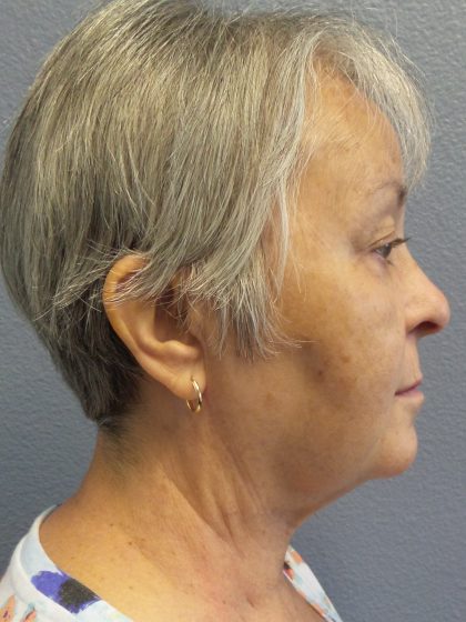 Liposuction of the Neck Before & After Patient #393