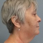 Liposuction of the Neck Before & After Patient #393