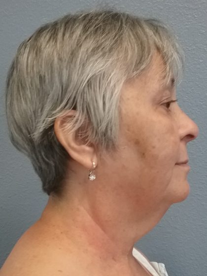 Liposuction of the Neck Before & After Patient #393