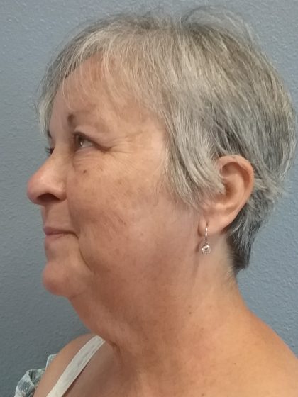 Liposuction of the Neck Before & After Patient #393