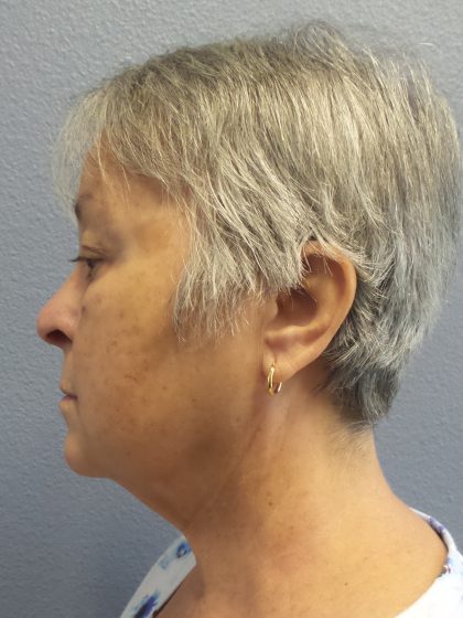 Liposuction of the Neck Before & After Patient #393