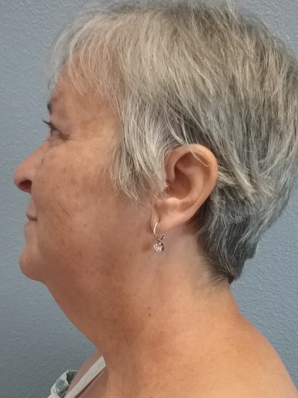 Liposuction of the Neck Before & After Patient #393