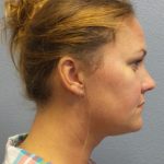 Liposuction of the Neck Before & After Patient #371