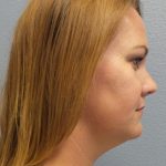 Liposuction of the Neck Before & After Patient #371