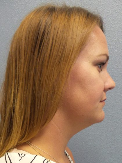 Liposuction of the Neck Before & After Patient #371