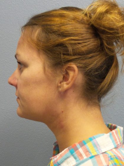 Liposuction of the Neck Before & After Patient #371