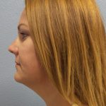 Liposuction of the Neck Before & After Patient #371