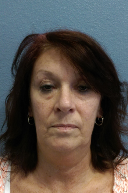 Liposuction of the Neck Before & After Patient #467