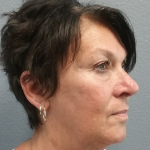 Liposuction of the Neck Before & After Patient #467