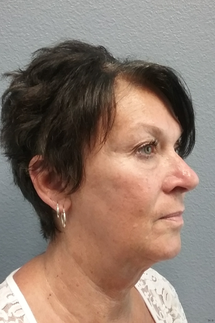 Liposuction of the Neck Before & After Patient #467