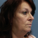 Liposuction of the Neck Before & After Patient #467