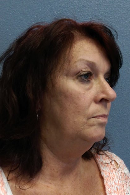 Liposuction of the Neck Before & After Patient #467