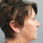 Liposuction of the Neck Before & After Patient #467
