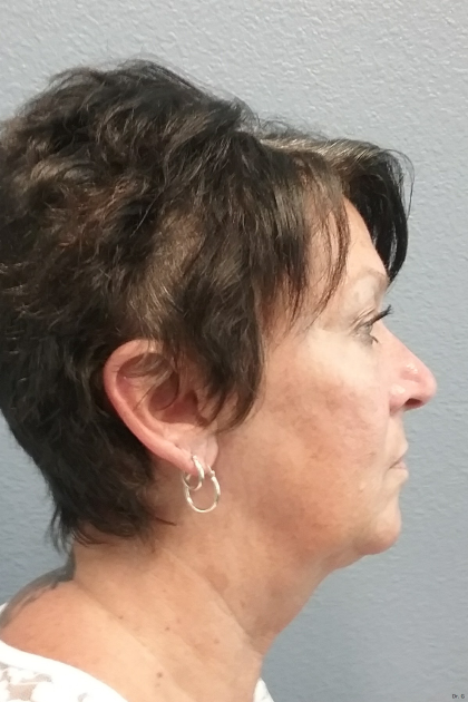 Liposuction of the Neck Before & After Patient #467