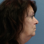 Liposuction of the Neck Before & After Patient #467