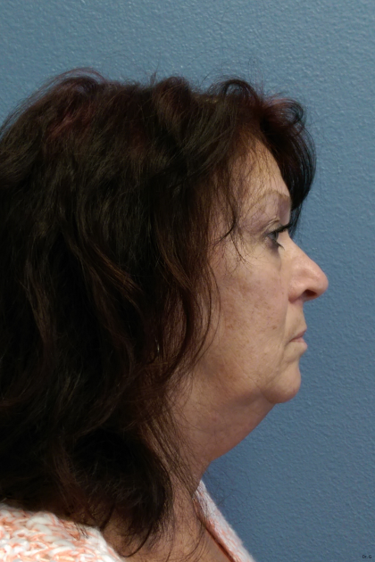 Liposuction of the Neck Before & After Patient #467