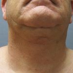 Liposuction of the Neck Before & After Patient #353
