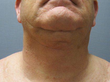 Liposuction of the Neck Before & After Patient #353