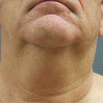 Liposuction of the Neck Before & After Patient #353