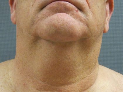 Liposuction of the Neck Before & After Patient #353