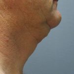 Liposuction of the Neck Before & After Patient #353