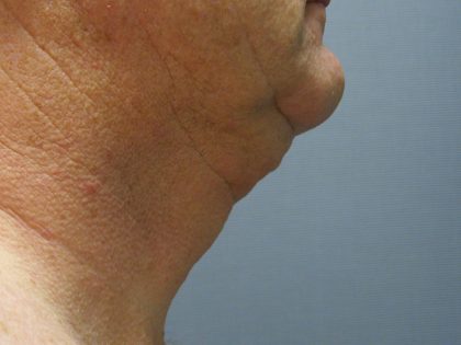 Liposuction of the Neck Before & After Patient #353