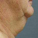 Liposuction of the Neck Before & After Patient #353