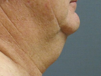 Liposuction of the Neck Before & After Patient #353