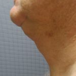 Liposuction of the Neck Before & After Patient #353