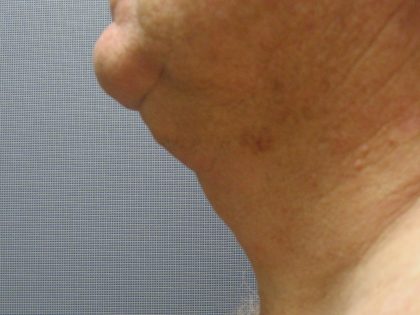 Liposuction of the Neck Before & After Patient #353