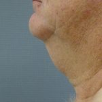 Liposuction of the Neck Before & After Patient #353