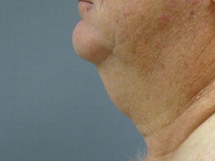 Liposuction of the Neck Before & After Patient #353