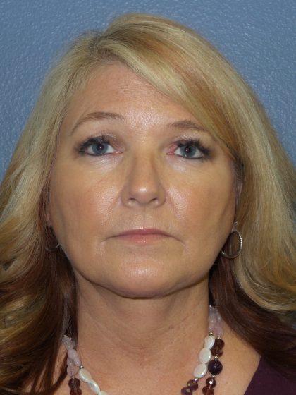 Liposuction of the Neck Before & After Patient #364