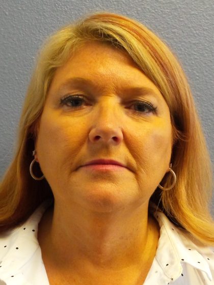 Liposuction of the Neck Before & After Patient #364