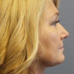 Liposuction of the Neck Before & After Patient #364