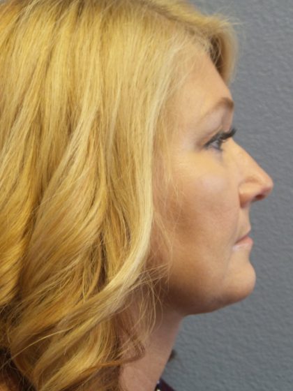 Liposuction of the Neck Before & After Patient #364