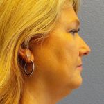 Liposuction of the Neck Before & After Patient #364