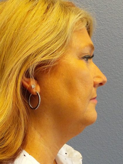 Liposuction of the Neck Before & After Patient #364
