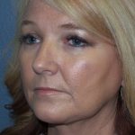 Liposuction of the Neck Before & After Patient #364