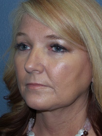 Liposuction of the Neck Before & After Patient #364