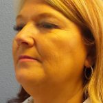 Liposuction of the Neck Before & After Patient #364