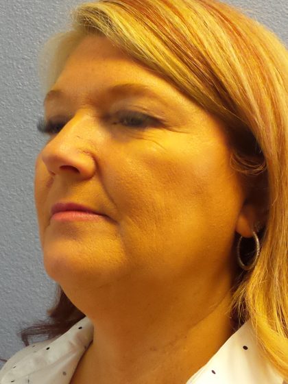 Liposuction of the Neck Before & After Patient #364