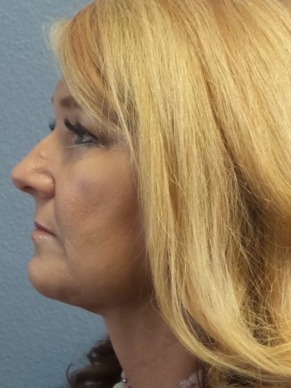 Liposuction of the Neck Before & After Patient #364