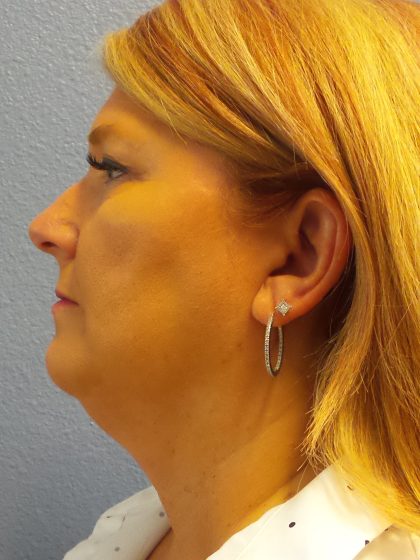 Liposuction of the Neck Before & After Patient #364