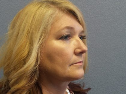 Liposuction of the Neck Before & After Patient #364